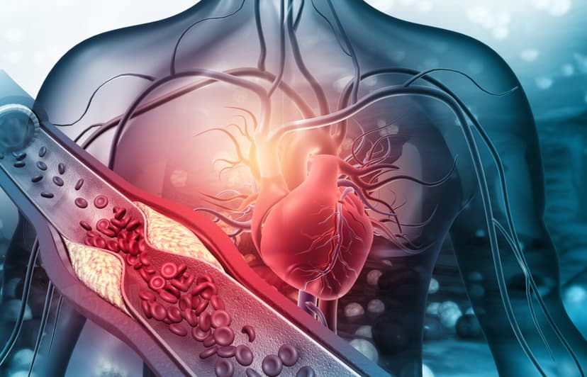 Coronary Artery Disease